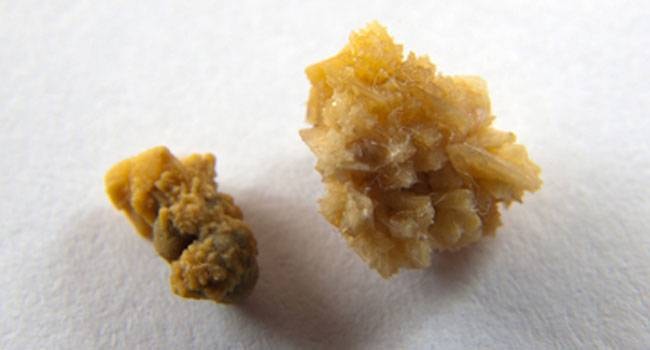 The kidney stone associated with William Shatner's unusual 2005 charity sale.