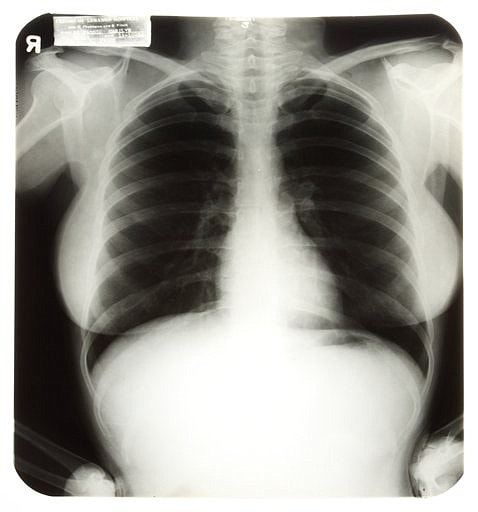 One of the medical X-ray images associated with Marilyn Monroe's 1954 hospital visit.